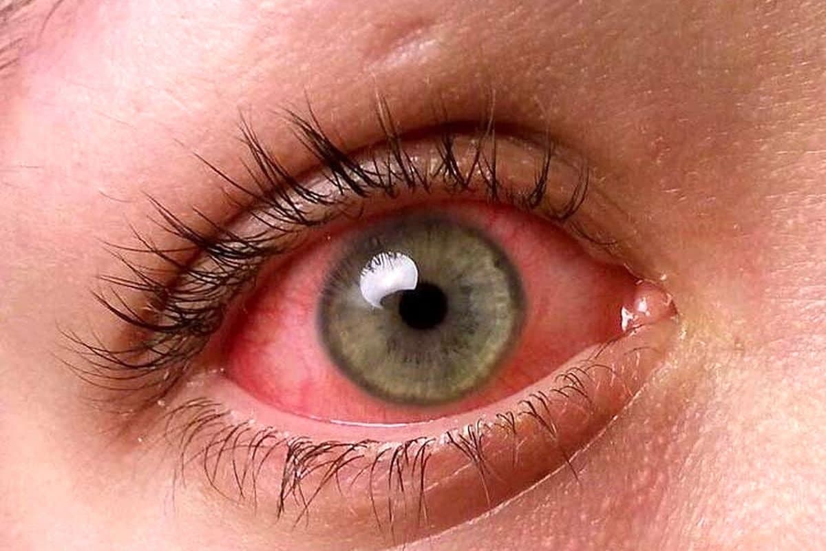  قرمزی چشم، ترشحات چشم و تب، ممکن است از علائم کرونا باشد!