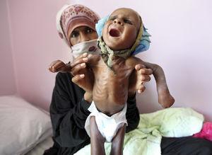 قتل عام هزاران کودک یمنی در سکوت مجامع جهانی/ جنگ خاموش عربستان و آمریکا در یمن/ اینجا هر 35 ثانیه یک کودک «وبا» می گیرد! +عکس(16+)