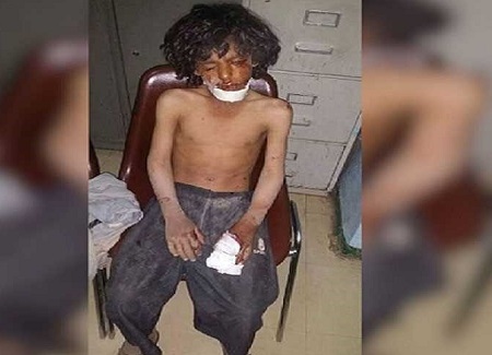 تبعات دردناک انفجار بمب خوشه ای بر کودکان یمن 