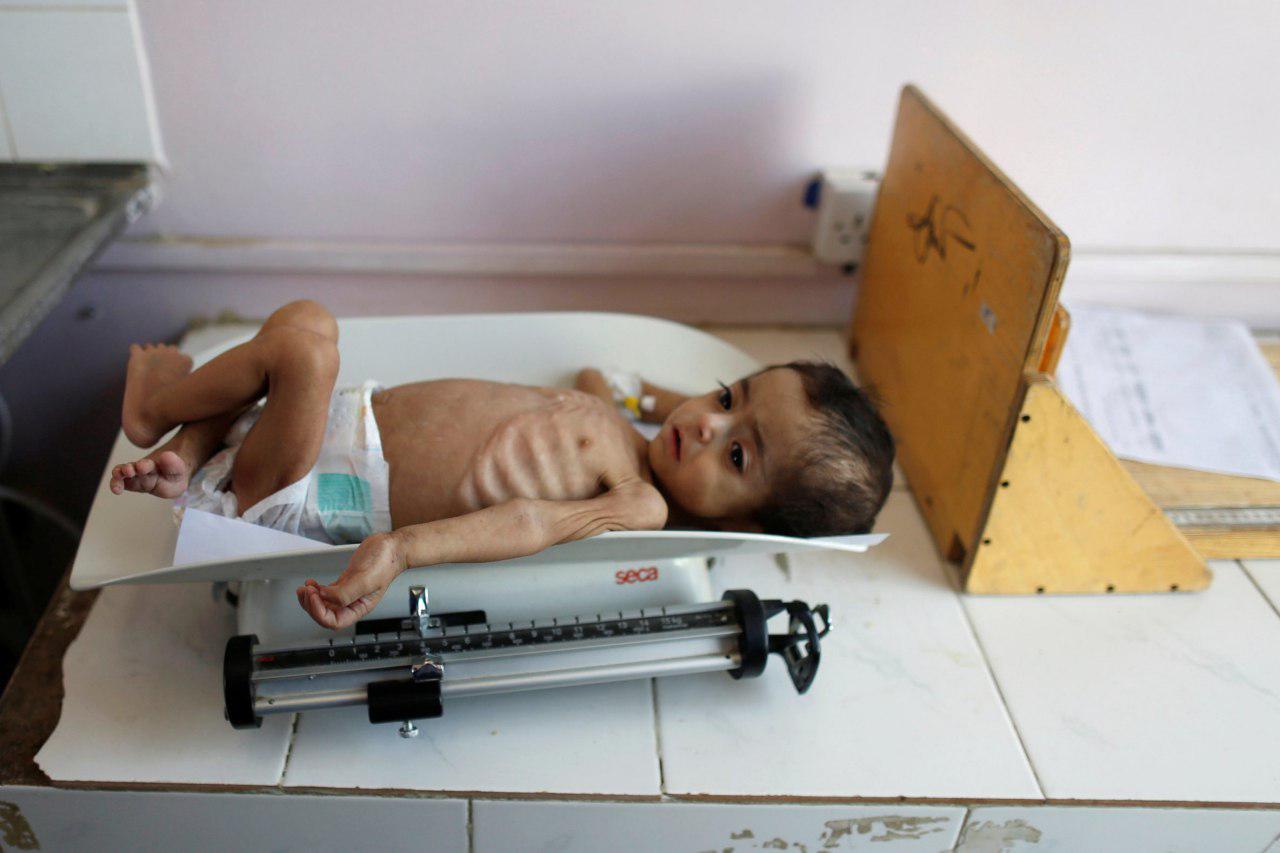 یمن؛ جایی که دنده های کودکان گرسنه  قابل شمارش است